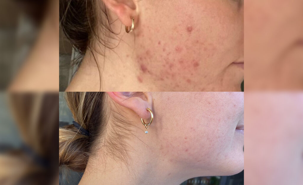 Case Study: Bye, Bye Blemishes!
